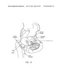 METHOD AND APPARATUS FOR RECONSTRUCTING A HIP JOINT, INCLUDING THE     PROVISION AND USE OF A NOVEL ARTHROSCOPIC DEBRIDEMENT TEMPLATE FOR     ASSISTING IN THE TREATMENT OF CAM-TYPE FEMOROACETABULAR IMPINGEMENT diagram and image