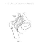 METHOD AND APPARATUS FOR RECONSTRUCTING A HIP JOINT, INCLUDING THE     PROVISION AND USE OF A NOVEL ARTHROSCOPIC DEBRIDEMENT TEMPLATE FOR     ASSISTING IN THE TREATMENT OF CAM-TYPE FEMOROACETABULAR IMPINGEMENT diagram and image