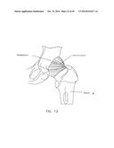 METHOD AND APPARATUS FOR RECONSTRUCTING A HIP JOINT, INCLUDING THE     PROVISION AND USE OF A NOVEL ARTHROSCOPIC DEBRIDEMENT TEMPLATE FOR     ASSISTING IN THE TREATMENT OF CAM-TYPE FEMOROACETABULAR IMPINGEMENT diagram and image