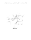 METHOD AND APPARATUS FOR RECONSTRUCTING A HIP JOINT, INCLUDING THE     PROVISION AND USE OF A NOVEL ARTHROSCOPIC DEBRIDEMENT TEMPLATE FOR     ASSISTING IN THE TREATMENT OF CAM-TYPE FEMOROACETABULAR IMPINGEMENT diagram and image