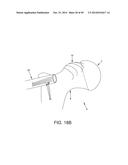 METHOD AND APPARATUS FOR RECONSTRUCTING A HIP JOINT, INCLUDING THE     PROVISION AND USE OF A NOVEL ARTHROSCOPIC DEBRIDEMENT TEMPLATE FOR     ASSISTING IN THE TREATMENT OF CAM-TYPE FEMOROACETABULAR IMPINGEMENT diagram and image