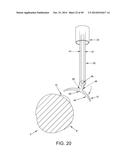 METHOD AND APPARATUS FOR RECONSTRUCTING A HIP JOINT, INCLUDING THE     PROVISION AND USE OF A NOVEL ARTHROSCOPIC DEBRIDEMENT TEMPLATE FOR     ASSISTING IN THE TREATMENT OF CAM-TYPE FEMOROACETABULAR IMPINGEMENT diagram and image