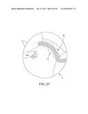 METHOD AND APPARATUS FOR RECONSTRUCTING A HIP JOINT, INCLUDING THE     PROVISION AND USE OF A NOVEL ARTHROSCOPIC DEBRIDEMENT TEMPLATE FOR     ASSISTING IN THE TREATMENT OF CAM-TYPE FEMOROACETABULAR IMPINGEMENT diagram and image