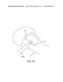 METHOD AND APPARATUS FOR RECONSTRUCTING A HIP JOINT, INCLUDING THE     PROVISION AND USE OF A NOVEL ARTHROSCOPIC DEBRIDEMENT TEMPLATE FOR     ASSISTING IN THE TREATMENT OF CAM-TYPE FEMOROACETABULAR IMPINGEMENT diagram and image