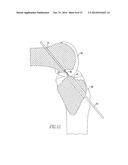 DEVICE AND METHOD FOR USE DURING LIGAMENT RECONSTRUCTION diagram and image