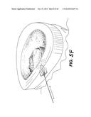 APPARATUS FOR THE TREATMENT OF TISSUE diagram and image