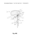 APPARATUS FOR THE TREATMENT OF TISSUE diagram and image