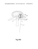 APPARATUS FOR THE TREATMENT OF TISSUE diagram and image