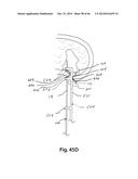 APPARATUS FOR THE TREATMENT OF TISSUE diagram and image