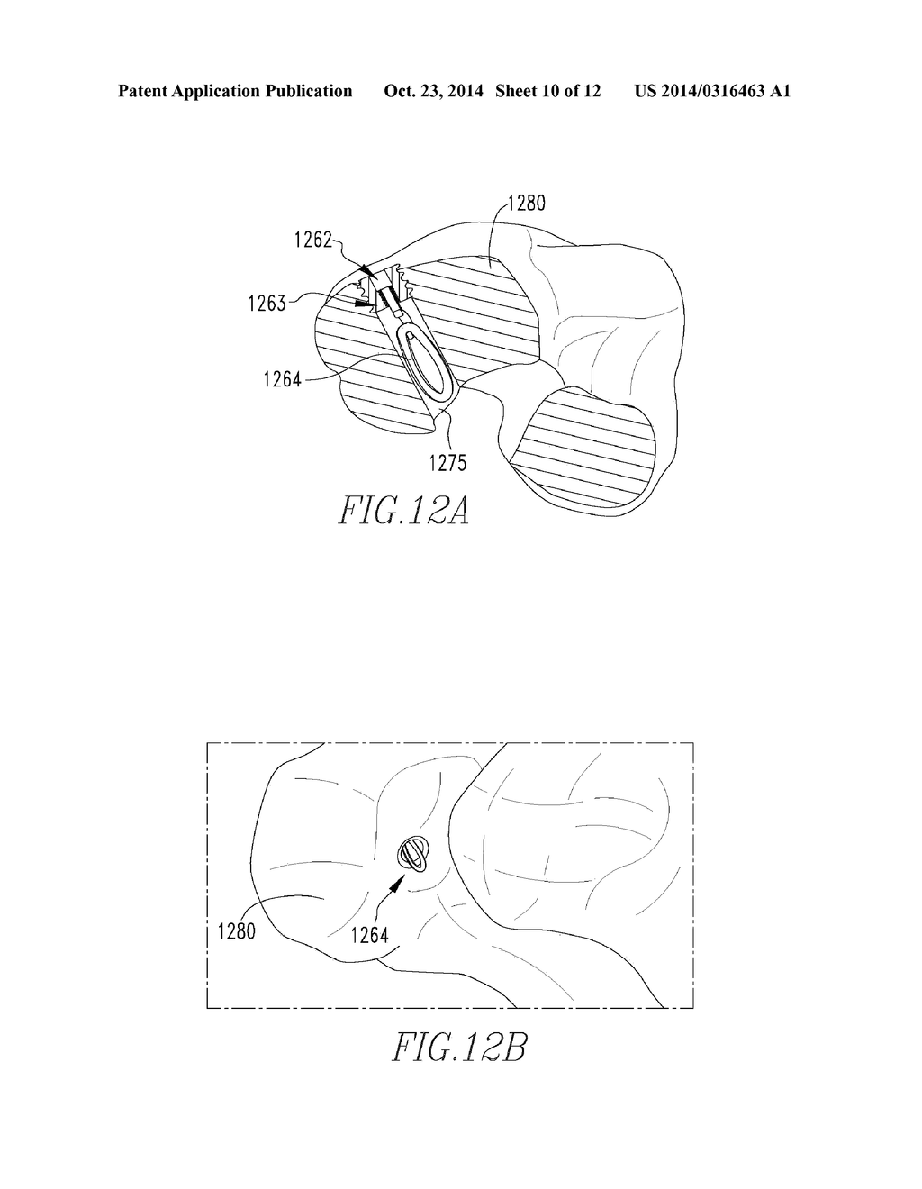 LIGAMENT SCREW ATTACHMENT DEVICE - diagram, schematic, and image 11