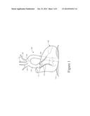 HEART VALVE AND ENDOVASCULAR GRAFT COMPONENTS AND METHOD FOR DELIVERY diagram and image