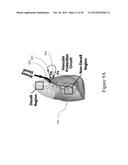 FUNCTIONAL RECOVERY OF HUMAN LUNGS FOR TRANSPLANTATION diagram and image