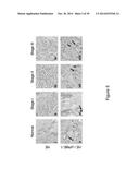 PME-1 AS A BIOMARKER TO PREDICT AND DIAGNOSE AN INCREASED RISK OF     ENDOMETRIAL CANCER AND GENE SILENCING OF PME-1 TO INHIBIT EPITHELIAL TO     MESENCHYMAL TRANSITION diagram and image