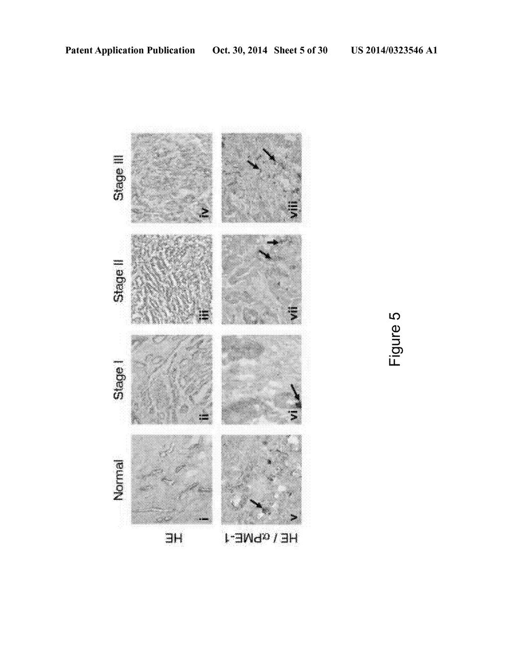 PME-1 AS A BIOMARKER TO PREDICT AND DIAGNOSE AN INCREASED RISK OF     ENDOMETRIAL CANCER AND GENE SILENCING OF PME-1 TO INHIBIT EPITHELIAL TO     MESENCHYMAL TRANSITION - diagram, schematic, and image 06