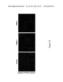 PME-1 AS A BIOMARKER TO PREDICT AND DIAGNOSE AN INCREASED RISK OF     ENDOMETRIAL CANCER AND GENE SILENCING OF PME-1 TO INHIBIT EPITHELIAL TO     MESENCHYMAL TRANSITION diagram and image