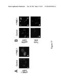 PME-1 AS A BIOMARKER TO PREDICT AND DIAGNOSE AN INCREASED RISK OF     ENDOMETRIAL CANCER AND GENE SILENCING OF PME-1 TO INHIBIT EPITHELIAL TO     MESENCHYMAL TRANSITION diagram and image