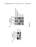 PME-1 AS A BIOMARKER TO PREDICT AND DIAGNOSE AN INCREASED RISK OF     ENDOMETRIAL CANCER AND GENE SILENCING OF PME-1 TO INHIBIT EPITHELIAL TO     MESENCHYMAL TRANSITION diagram and image