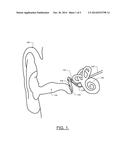 Middle Ear Implant Sensor diagram and image