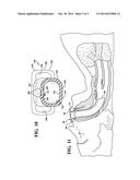 OROPHARYNGEAL AIRWAY diagram and image