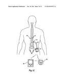 ANCHOR SLEEVE FOR IMPLANTABLE LEAD diagram and image