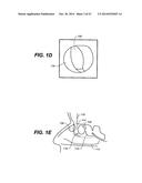 DEVICES AND METHODS FOR DELIVERING ACTIVE AGENTS TO THE OSTEOMEATAL     COMPLEX diagram and image