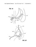 DEVICES AND METHODS FOR DELIVERING ACTIVE AGENTS TO THE OSTEOMEATAL     COMPLEX diagram and image