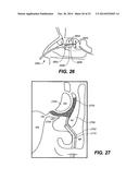 DEVICES AND METHODS FOR DELIVERING ACTIVE AGENTS TO THE OSTEOMEATAL     COMPLEX diagram and image