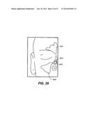 DEVICES AND METHODS FOR DELIVERING ACTIVE AGENTS TO THE OSTEOMEATAL     COMPLEX diagram and image