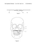 Transport Distraction Apparatus diagram and image