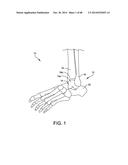 ORTHOPEDIC SURGICAL GUIDE diagram and image