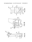 ORTHOPEDIC SURGICAL GUIDE diagram and image