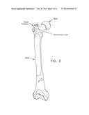 APPARATUS AND METHOD FOR DISTRACTING THE HIP JOINT diagram and image