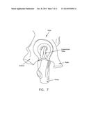 APPARATUS AND METHOD FOR DISTRACTING THE HIP JOINT diagram and image