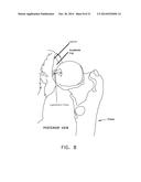 APPARATUS AND METHOD FOR DISTRACTING THE HIP JOINT diagram and image