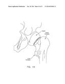 APPARATUS AND METHOD FOR DISTRACTING THE HIP JOINT diagram and image