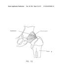 APPARATUS AND METHOD FOR DISTRACTING THE HIP JOINT diagram and image