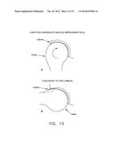 APPARATUS AND METHOD FOR DISTRACTING THE HIP JOINT diagram and image