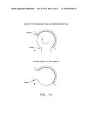 APPARATUS AND METHOD FOR DISTRACTING THE HIP JOINT diagram and image