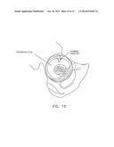 APPARATUS AND METHOD FOR DISTRACTING THE HIP JOINT diagram and image