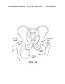 APPARATUS AND METHOD FOR DISTRACTING THE HIP JOINT diagram and image