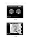 APPARATUS AND METHOD FOR DISTRACTING THE HIP JOINT diagram and image