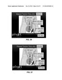 APPARATUS AND METHOD FOR DISTRACTING THE HIP JOINT diagram and image