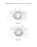 TISSUE RESECTING SYSTEMS AND METHODS diagram and image