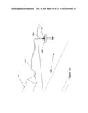 INFLATABLE MEDICAL DEVICES diagram and image