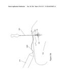 INFLATABLE MEDICAL DEVICES diagram and image