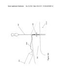 INFLATABLE MEDICAL DEVICES diagram and image