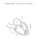 INFLATABLE MEDICAL DEVICES diagram and image