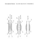 INFLATABLE MEDICAL DEVICES diagram and image