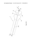 INFLATABLE MEDICAL DEVICES diagram and image