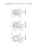 INFLATABLE MEDICAL DEVICES diagram and image